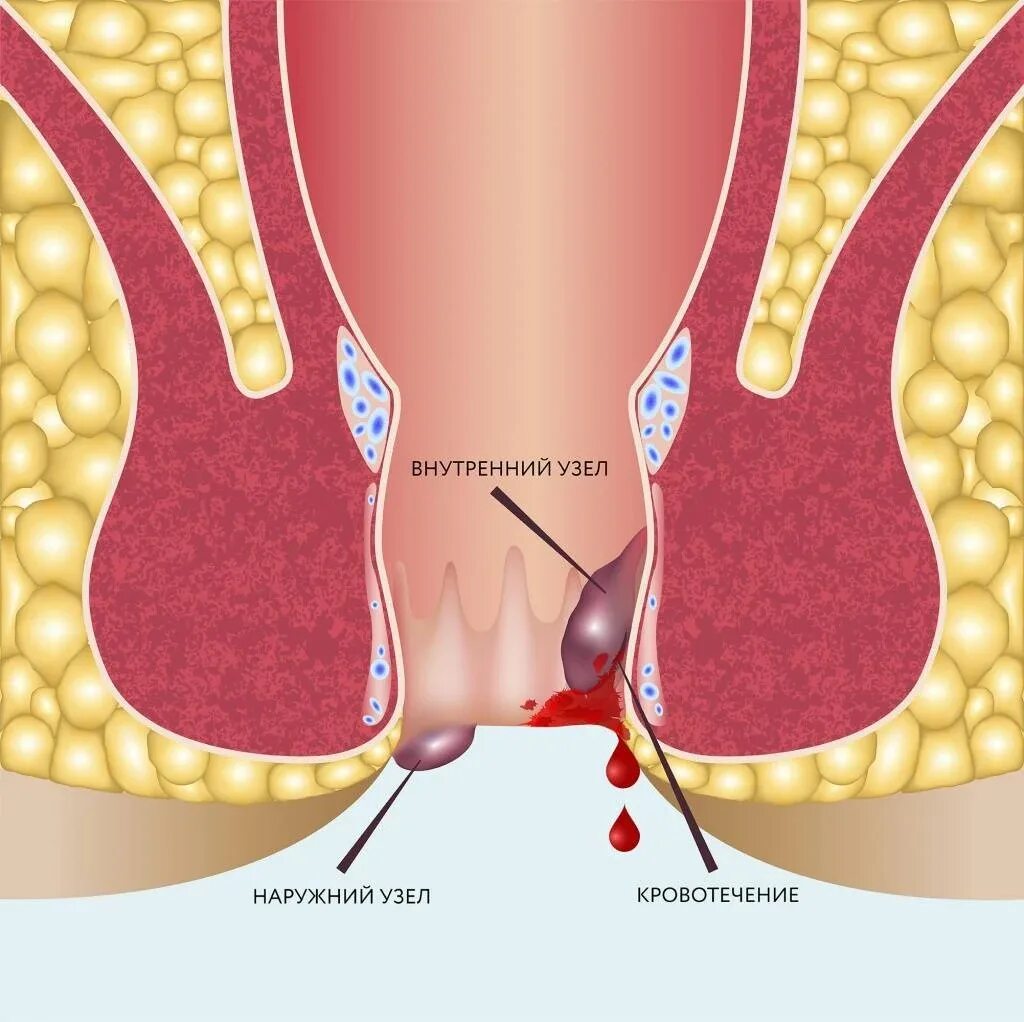 Причина кровотечения из заднего прохода у мужчин. Хронический внутренний геморрой.