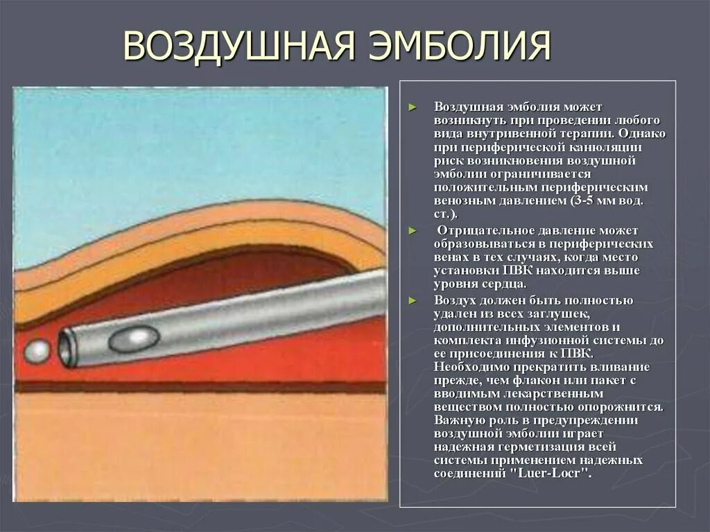 Воздушная эмболия при инъекции. Постинъекционные осложнения воздушная эмболия. воздушная эмболия возникает при повреждении сосудов. эмболия при внутривенных инъекциях. воздушная эмболия в подключичной вене.
