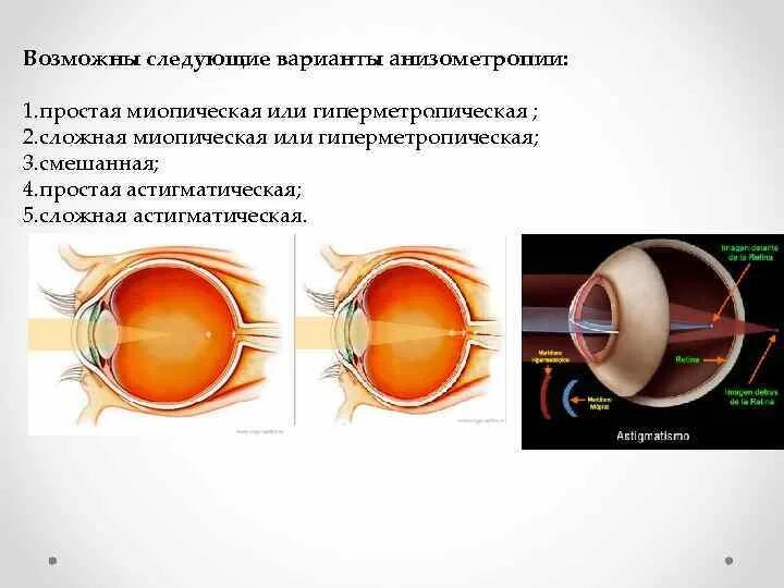 Анизометропия это в офтальмологии. Анизометропия слабой степени. Миопическая анизометропия. Осевая анизометропия. Гиперметропическая анизометропия.