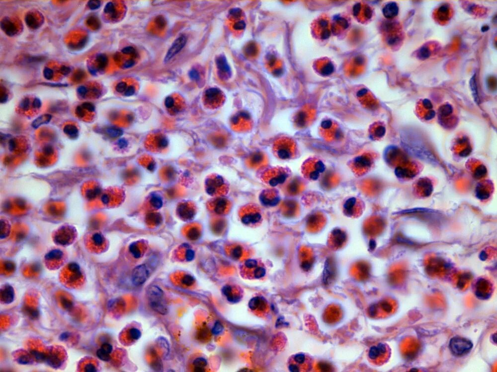 эозинофильный эзофагит рекомендации