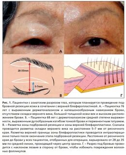 Блефаропластика разрез