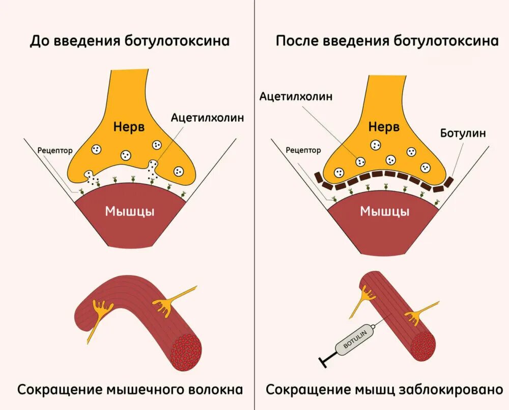 Ботулотоксин в что это такое. Механизм действия ботулинического токсина типа а. ботулотоксин механизм действия. принцип действия ботулотоксина. механизм действия ботулотоксинов.