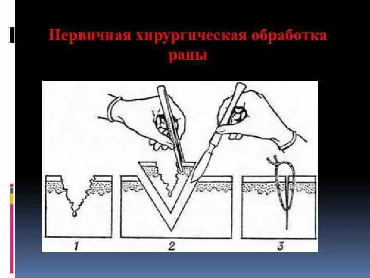 Механическая антисептика