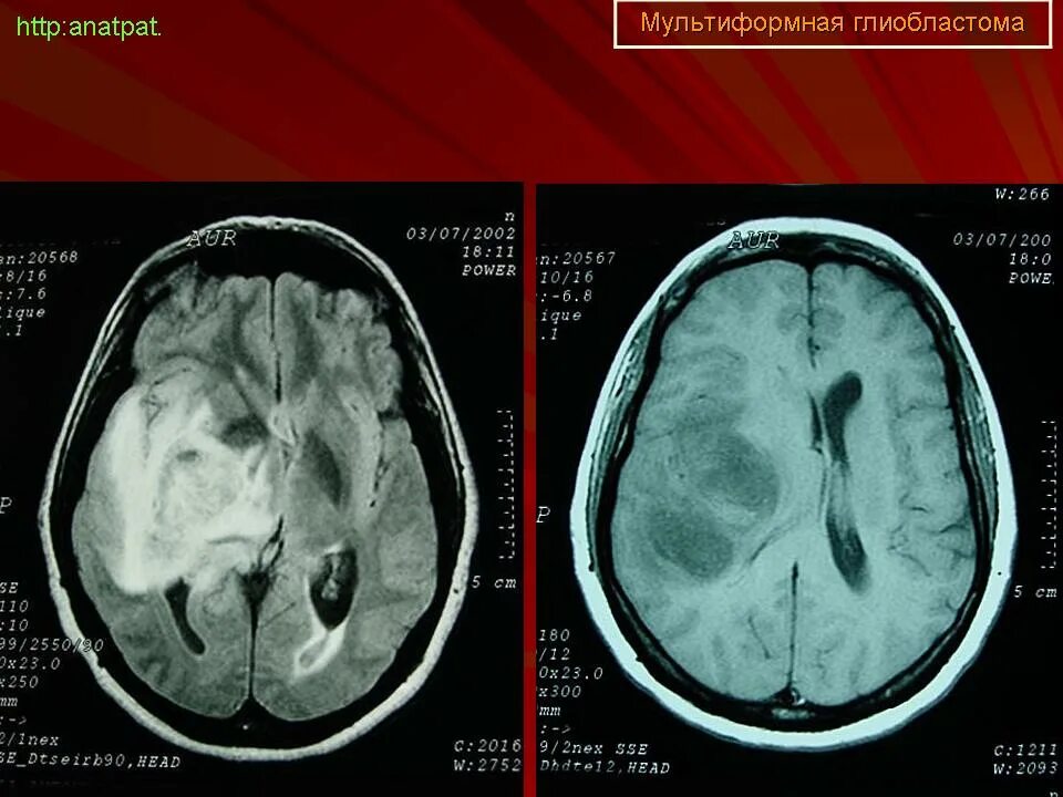 Глиобластома головного мозга на кт. Мультиформная глиобластома. Мультиполярная глиобластома.