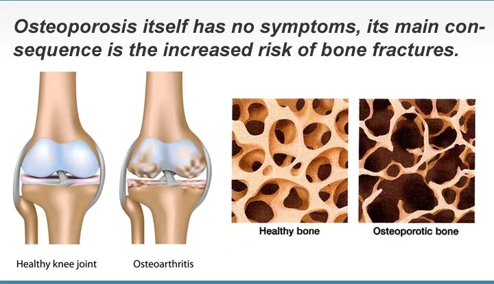 Bone mineral