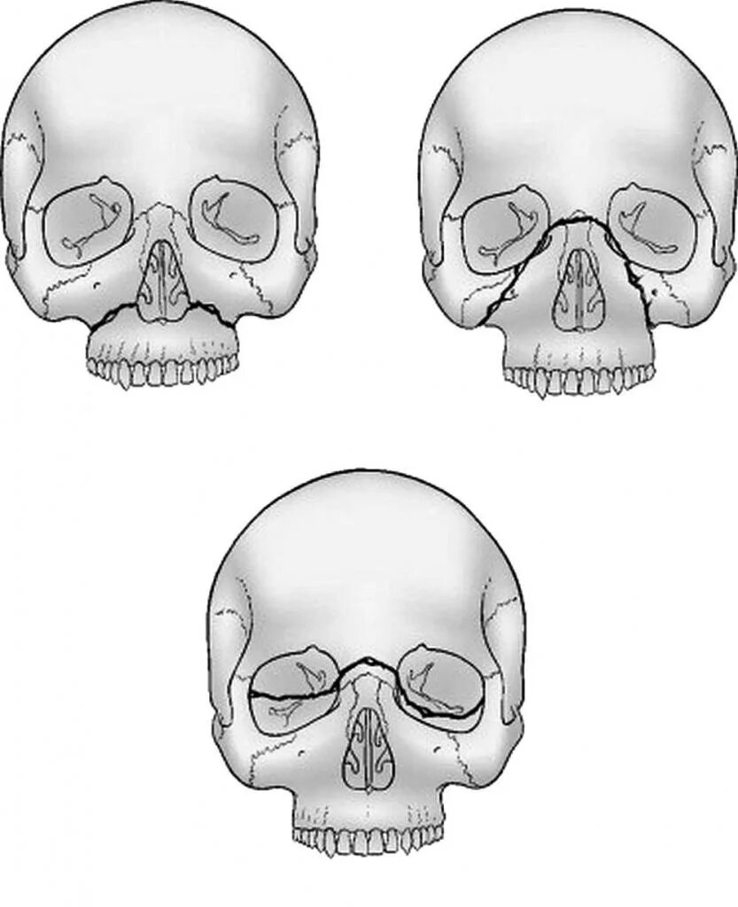 Деформация кости черепа. Череп перелом скуловой кости. Перелом скуловой кости верхней челюсти. Оскольчатый перелом скуловой кости. Перелом лицевой кости черепа.