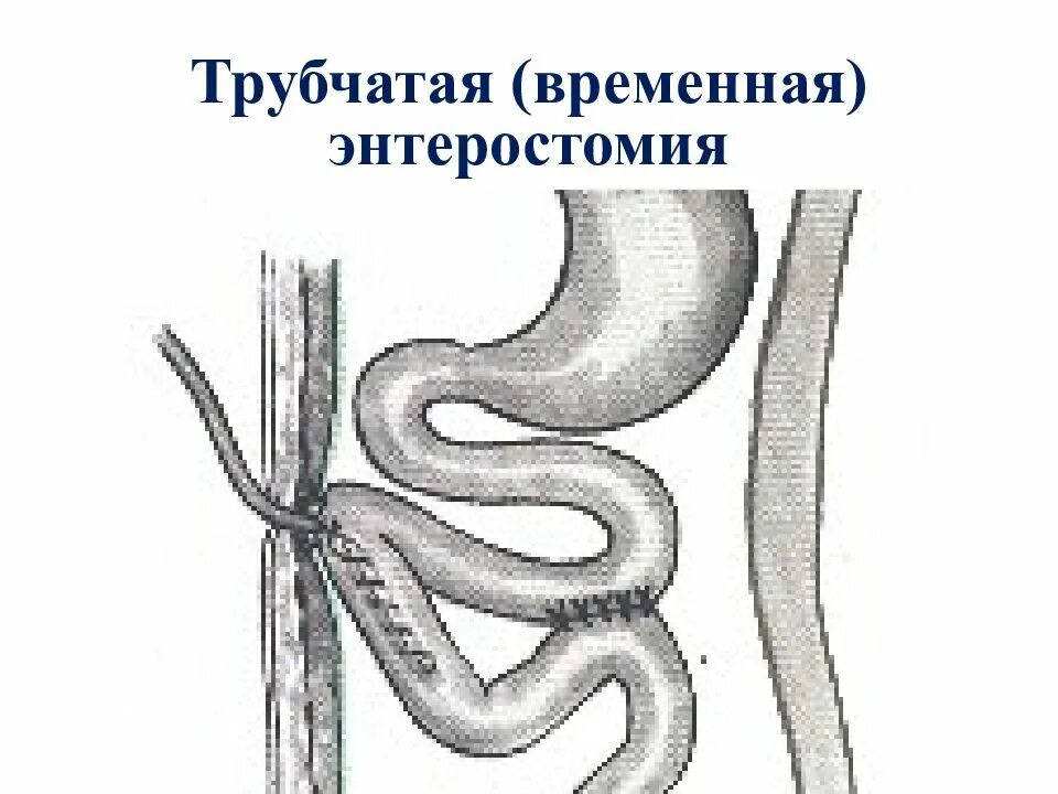 Еюностома это. Гастростома и еюностома. гастростома свищ желудка. энтеростомия топографическая анатомия.