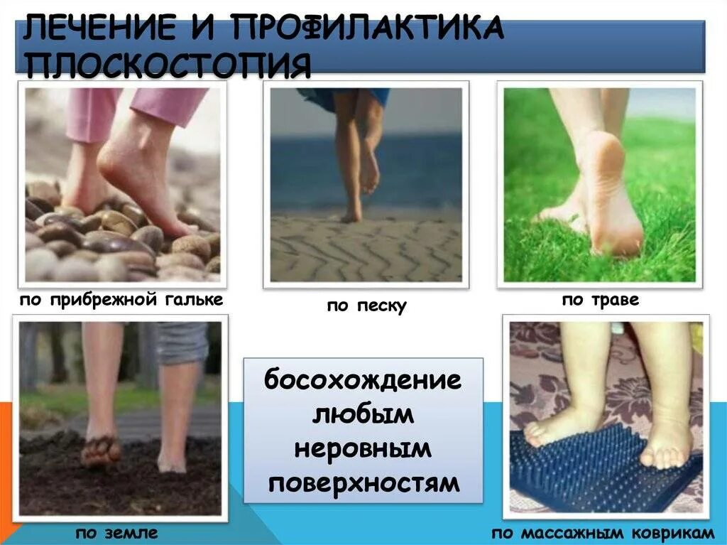 Плоскостопие у детей причины и лечение. Причины плоскостопия у детей. профилактика плоскостопия у детей. плоскостопие у детей фото. плоскостопие у детей причины профилактика и методы лечения.