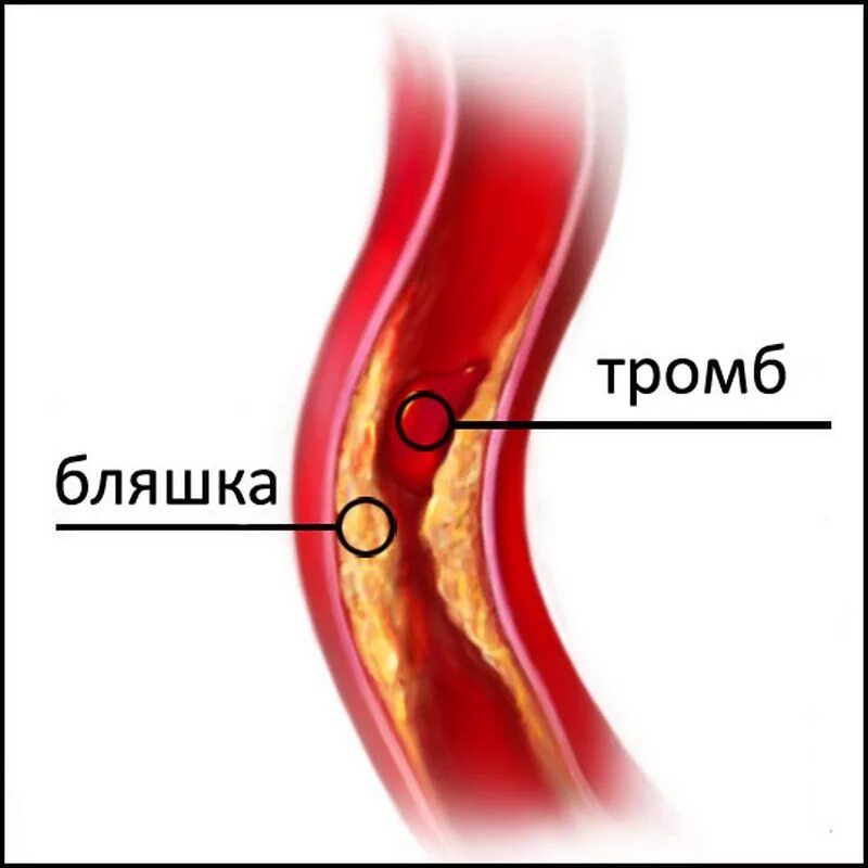 Чем отличается тромб