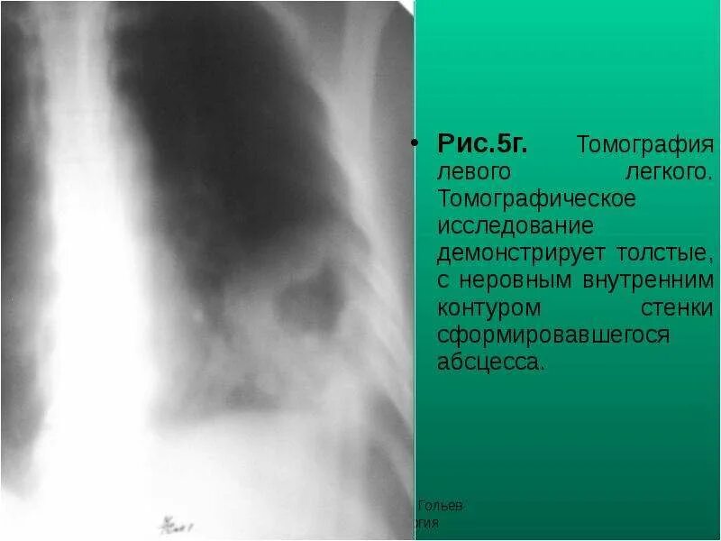 Легочный рисунок деформирован. Неровный контур легких. Метастазы на флюорографии. Контур легких. Солитарная туберкулема.