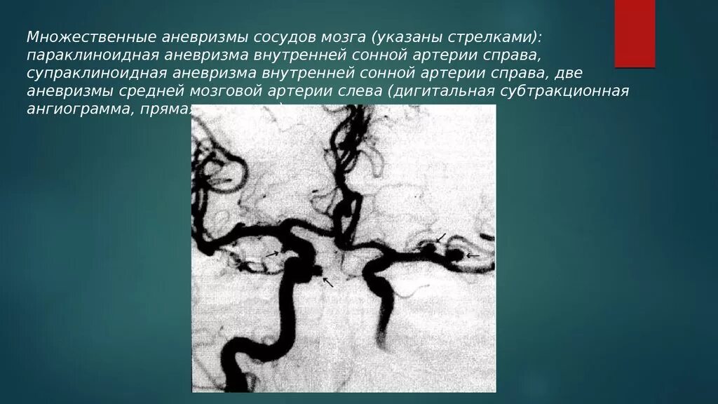 Аневризм сонной артерии головного мозга. Аневризма среднемозговой артерии. Аневризма сонной артерии кт. Спраклиноиднаz аневризма.