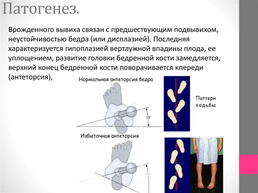 Вывих бедра тест. Врожденный вывих бедра патогенез. этиопатогенез врожденного вывиха бедра. антеверсия тазобедренного сустава. врожденный вывих бедра этиология.