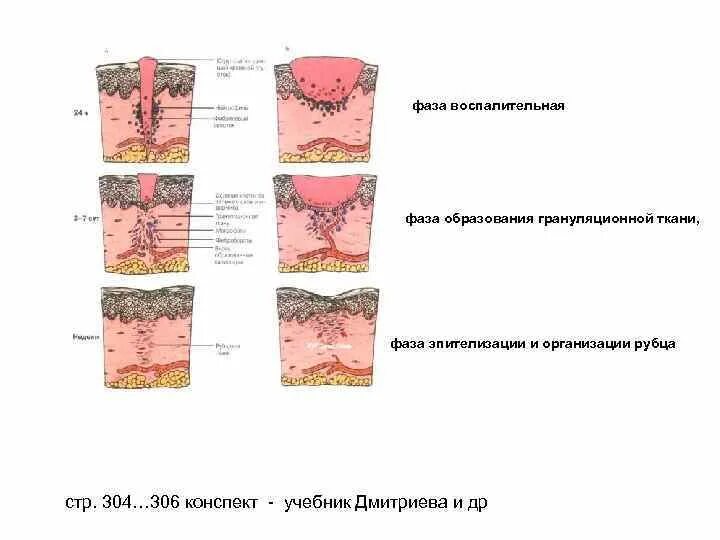 Стадии заживления после. Заживление РАН грануляционная ткань. Грануляционно-фиброзная ткань. Стадии образования грануляционной ткани. Грануляционная ткань этапы.