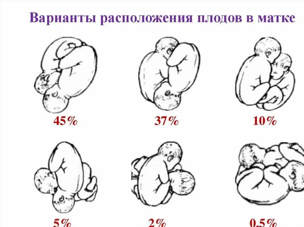 Положение плода в животе. Расположение ребенка в утробе схема. Положение плода по неделям. Варианты расположения плода в матке.