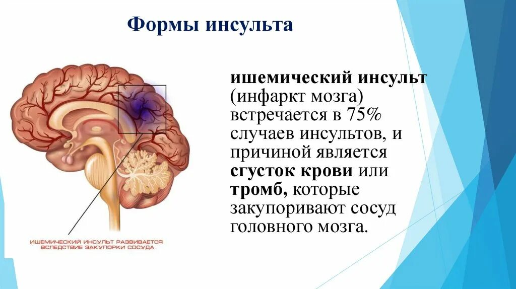 Почему после микроинсульта