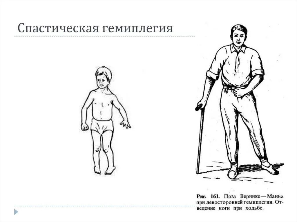 ДЦП спастический гемипарез. Правосторонняя гемиплегия очаг поражения. Двойная гемиплегия форма ДЦП. ДЦП, гемиплегическая форма (правосторонний гемипарез). Гемипаретическая форма дцп