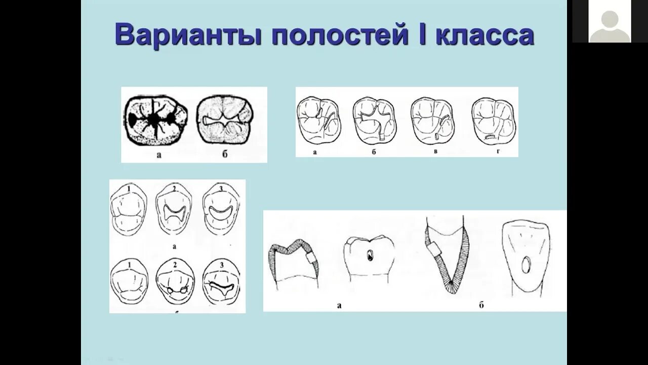 Iv класс блэка. Кариозные полости 2 класса по блэку. полость по 1 классу по блэку. полость 3 класса по блэку.