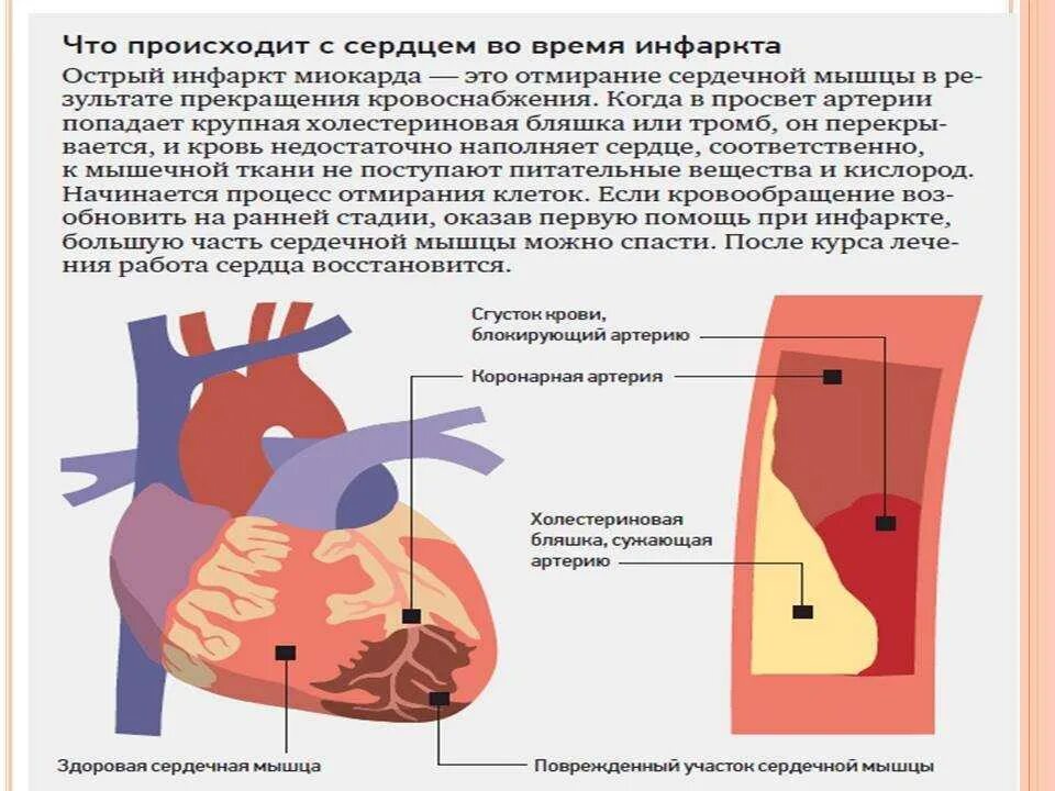 Вокруг очага инфаркта миокарда развивается. Инфаркт миокарда симптомы. Обширный инфаркт миокарда симптомы. Инфаркт миокарда сердце.