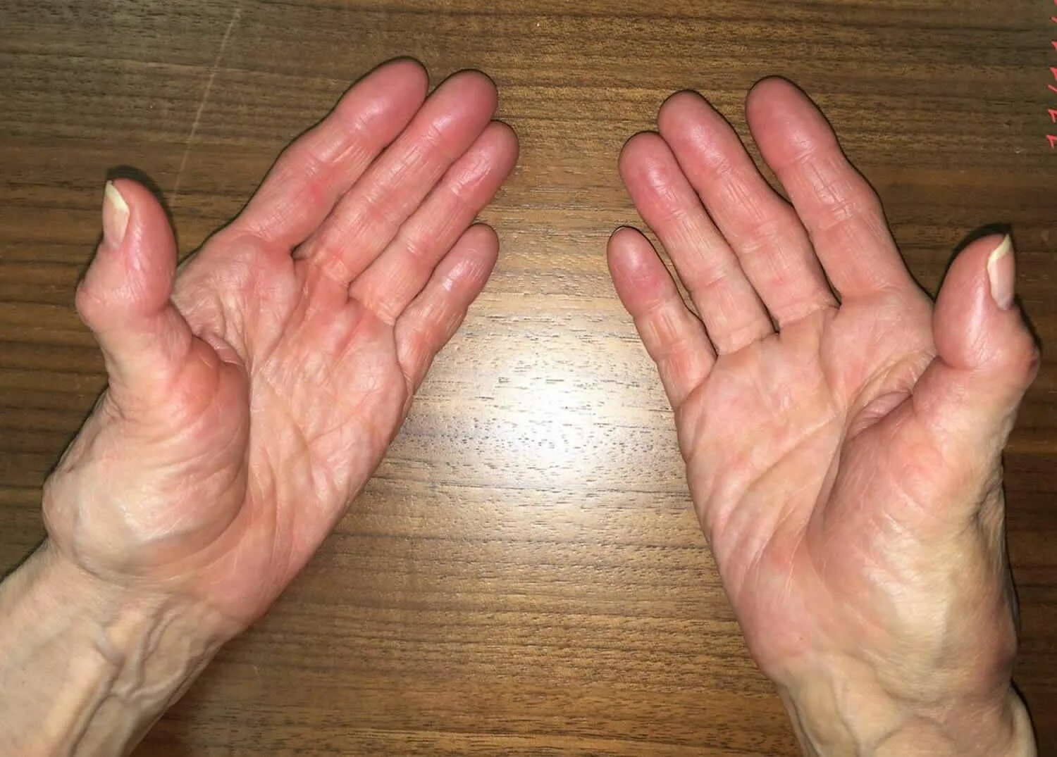 Болят большие пальцы рук лечение. Воспаление сустава на пальце руки.