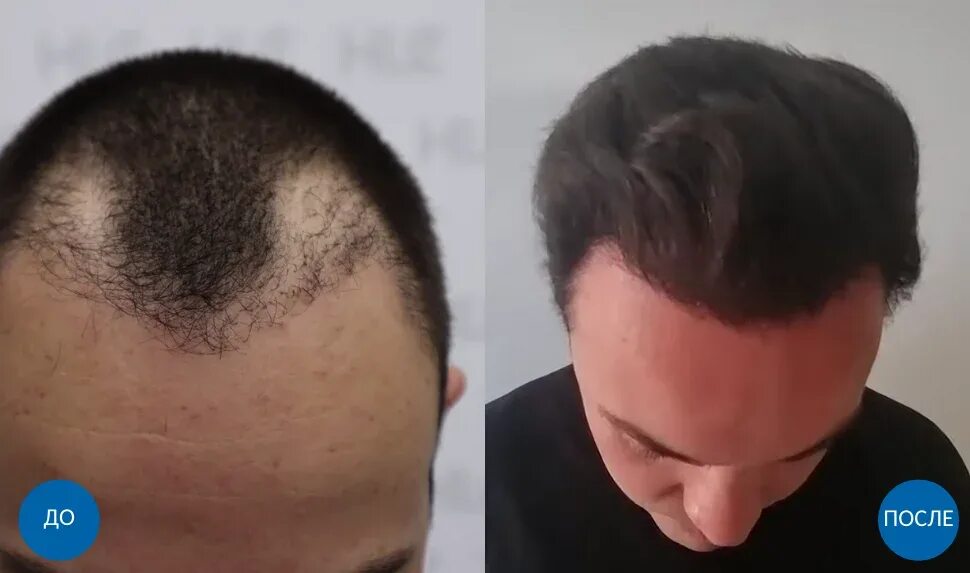 Волосы после пересадки волос. До и после пересадки волос. Голова после пересадки волос.