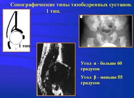 Тип тазобедренного сустава 2а