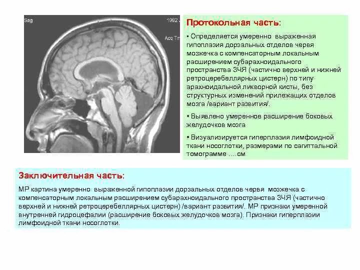 Умеренно расширение конвекситальных пространств