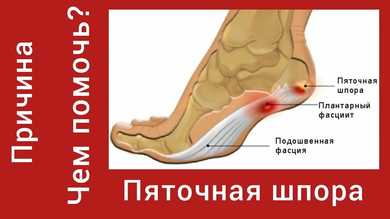 Подошвенные и пяточные шпоры. Обувь при пяточной шпоре. Какую обувь носить при пяточной шпоре. Кто лечит пяточную шпору