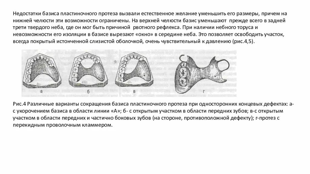 Толщина базиса. Элементы частичного съемного пластиночного протеза. Односторонний концевой дефект протез. Односторонний концевой дефект съемный протез. Конструкционные элементы съемных пластиночных протезов.