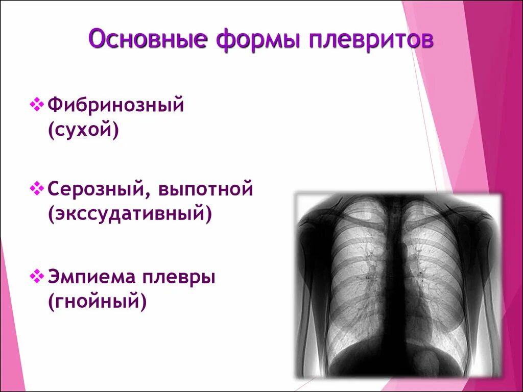 Положение при плеврите. Положение при плеврите