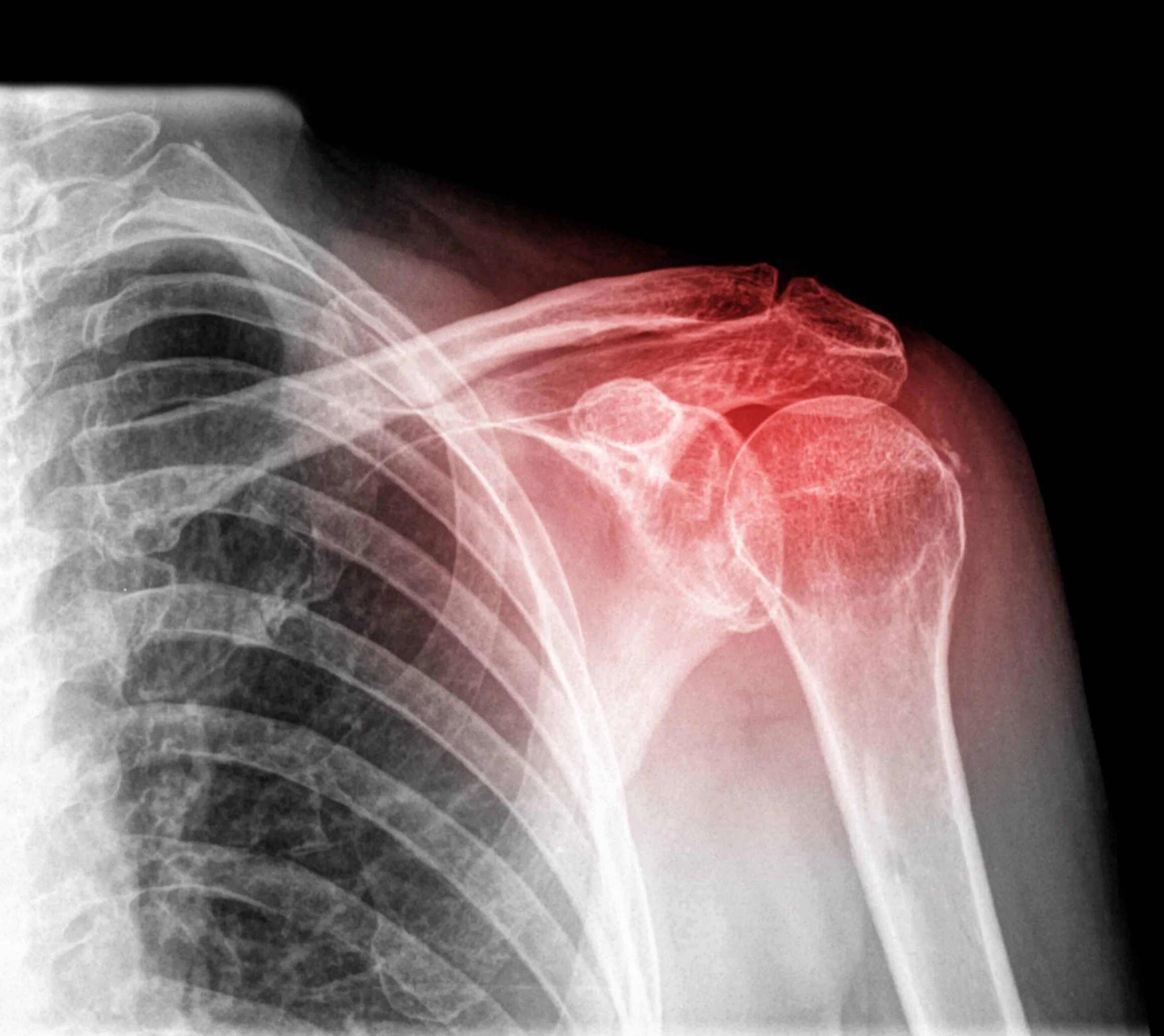 Вывих левого плечевого сустава рентген. Плексит плечевого сустава рентген. Посттравматический омартроз плечевого сустава. Остеоартроз плечевого сустава рентгенограмма.