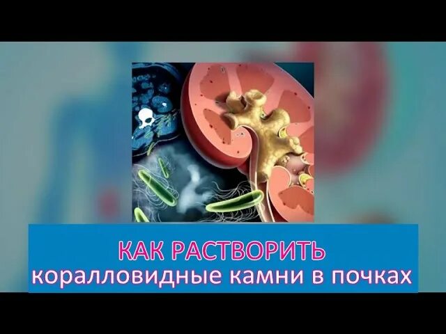 Можно ли растворить камни в почках. Растворение коралловых камней в почках. операция по удалению коралловидных камней из почки. коралловидные камни в почках клиника. коралловидный камень в почке как избавиться.