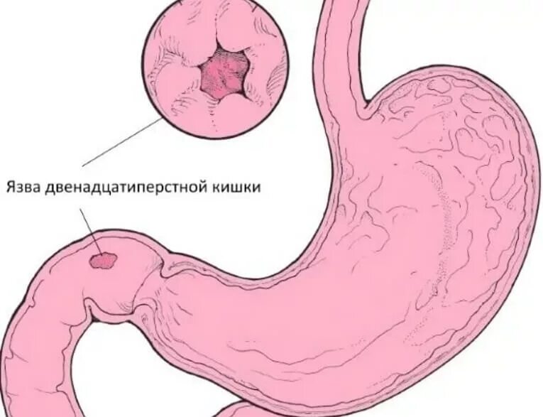 Фрукты при язве двенадцатиперстной кишки. Язвенная болезнь желудка и 12 перстной кишки. Язва 12 перстной кишки кишки. Яб желудка и 12 перстной кишки. Язва желудка и язва 12 перстной кишки.