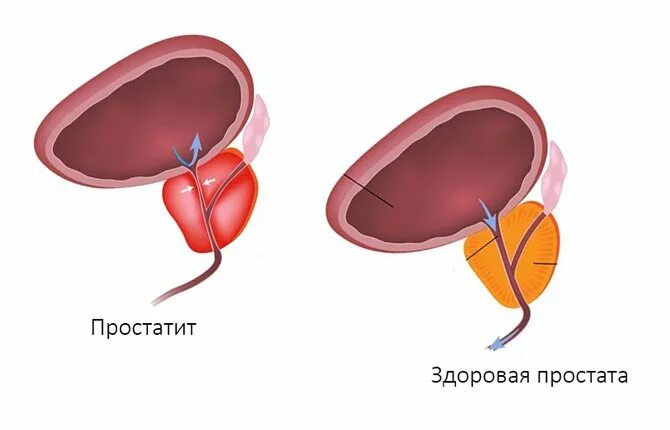 Простатит рисунок. Степени простатита