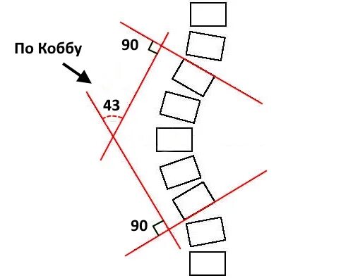 Измерение угла деформации по коббу. Угол искривления по методу Кобба. Метод измерения угла деформации по коббу. Угол искривления позвоночника по коббу. Угол кобба