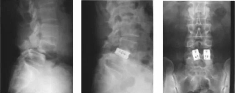 Кейджи поясничного отдела позвоночника. Кейджи поясничного отдела позвоночника. Транспедикулярная фиксация l4 l5 s1. Транспедикулярная фиксация l5-s1 позвонков. Титановые кейджи для позвоночника.