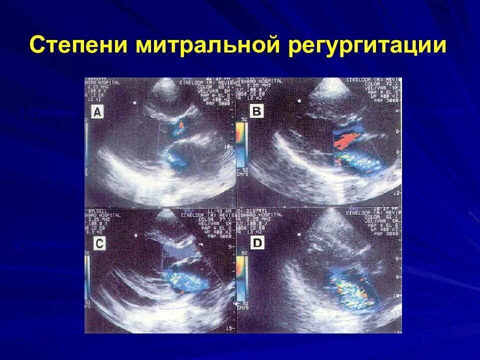 Миксоматозная дегенерация. Парапротезная фистула митрального клапана. Парапротезная регургитация аортального клапана. Приклапанная регургитация. Миксоматозная дегенерация митрального клапана ЭХОКГ.