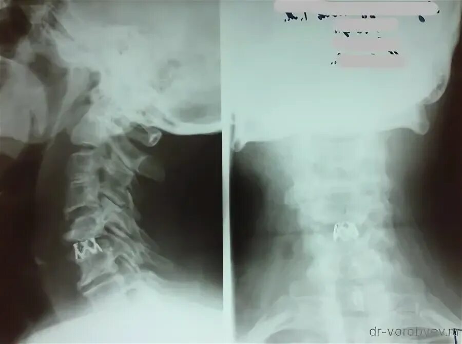 Импланты шейного отдела позвоночника. Имплант в шейном отделе позвоночника. Бисегментарный имплант шейного отдела позвоночника. Новейшие импланты шейного отдела позвоночника.