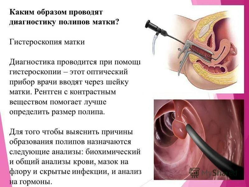 Сколько длится удаление полипов в матке. Полип эндометрия гистероскопия. Гистероскопия полипэктомия. . Гистероскопия (субмукозные узлы)..