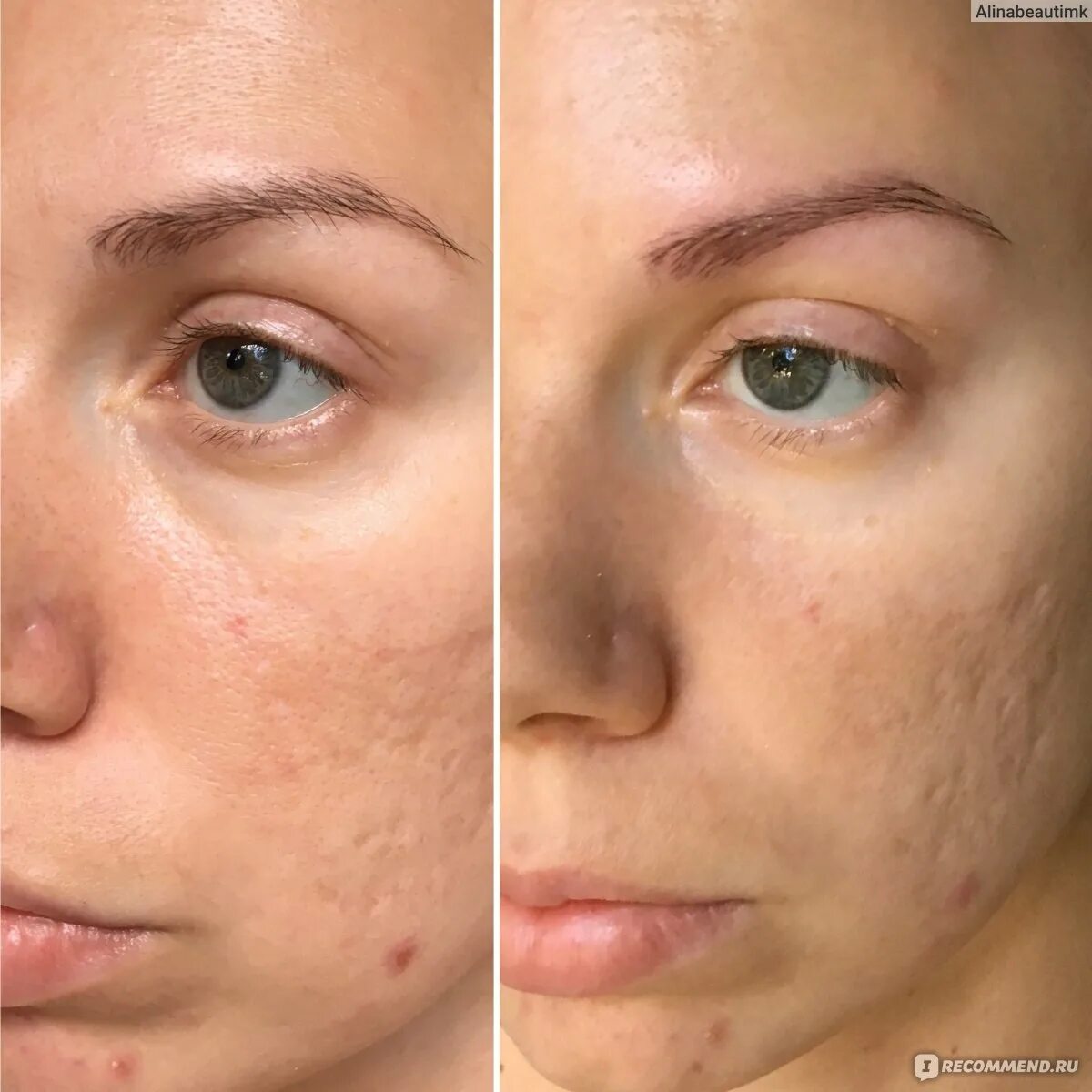 Альгинатная маска до и после фото. Альгинатная маска для лица эффект до и после применения. Результат альгинатная макси до и после лицо 10 применений. Альгинатная маска до и после