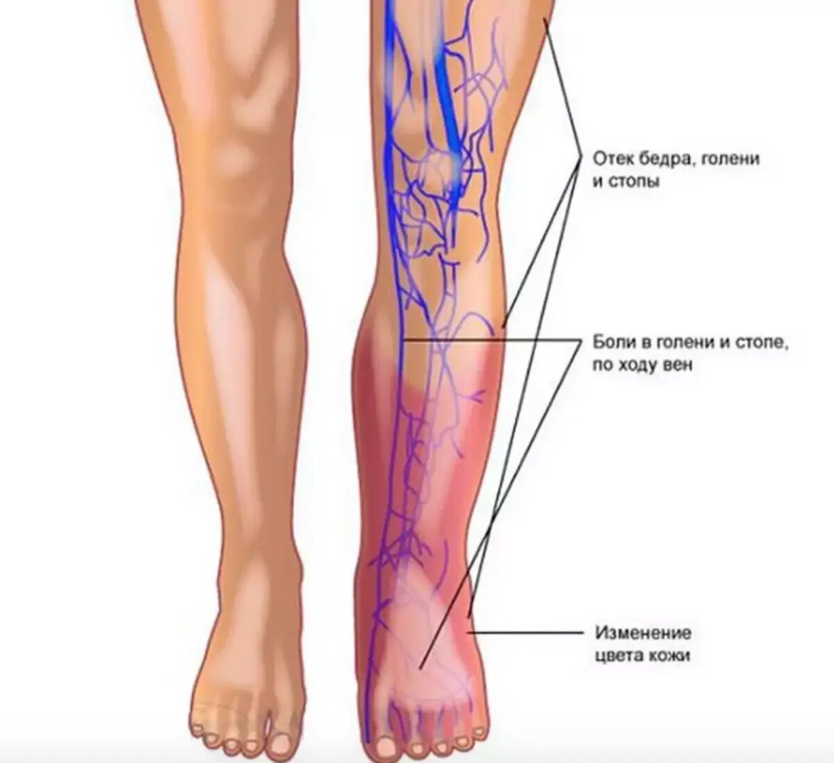 Немеет ляжка. Трофические язвы на варикозных венах. Тромбофлебит кубитальной вены. Поверхностный флебит, тромбофлебит. Флебит тромбофлебит флеботромбоз.