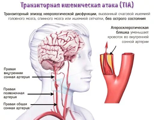 Сколько живут с ишемией. Транзиторная ишемическая атака симптомы. Транзиторная ишемическая атака головного мозга. Транзиторный ишемический инсульт. Транзиторная ишемия головного мозга.