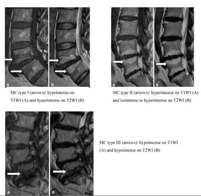 Склероз замыкательных пластинок позвоночника. Modic 1 мрт. Modic 2 на мрт. Жировая дегенерация костного мозга по типу Modic 2. Modic 1 классификация.