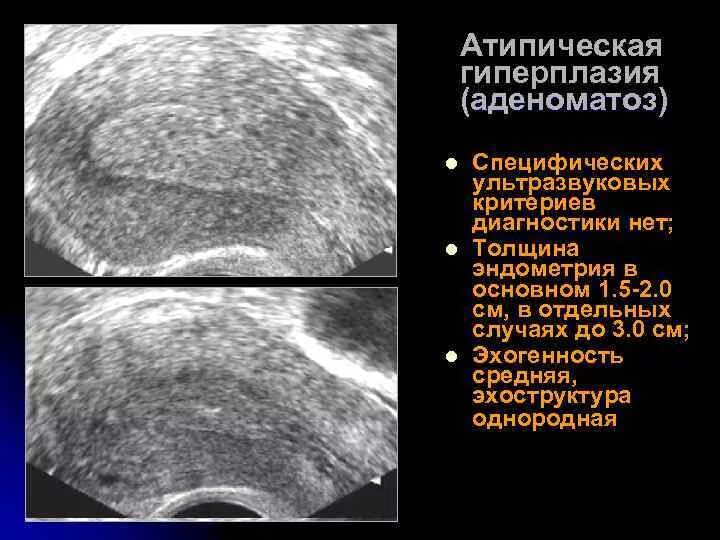 Полиповидная гиперплазия. Атипическая гиперплазия эндометрия терапия. Кистозная гиперплазия эндометрия на УЗИ. Атипическая гиперплазия эндометрия УЗИ.