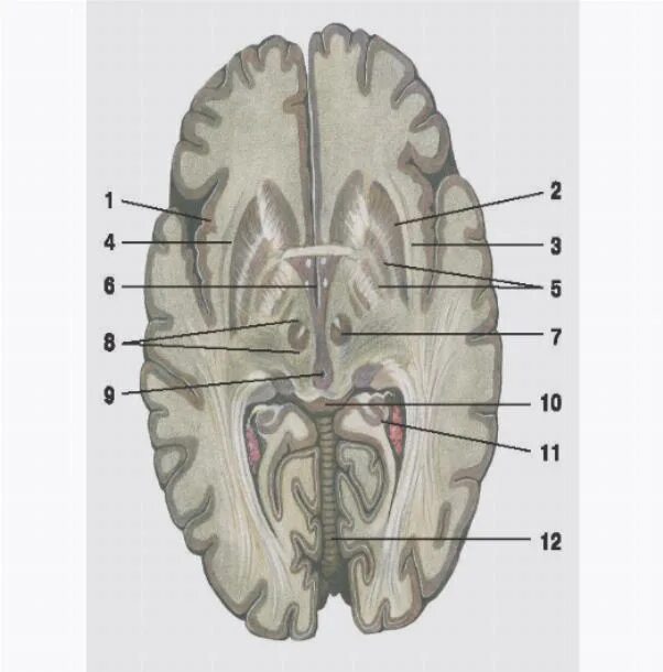 Правый желудочек головного. Третий желудочек головного мозга анатомия. Стенки третий желудочек анатомия. Препарат мозга анатомия. Анатомия желудочков мозга Лушко и рожанди моданжи.
