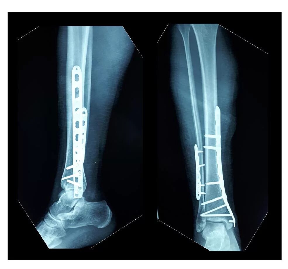 Трещина голени. Остеосинтез перелома костей голени. Перелом большеберцовой кости. Винтообразный перелом голени. Биос остеосинтез большеберцовой кости.