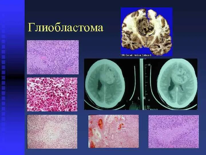 Глиобластома мозга симптомы. Мультиформная глиобластома патогенез. Глиобластома головного гистология. Глиобластома головного мозга гистология. Глиобластома головного мозга макропрепарат.