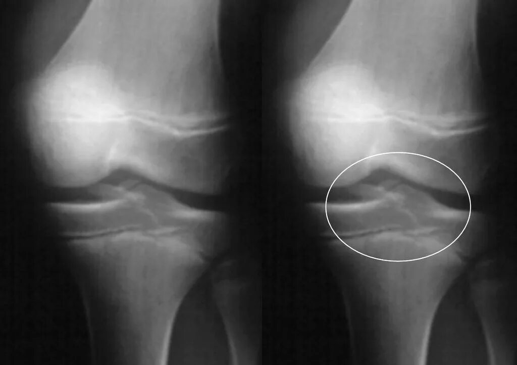 Мениск коленного сустава рентген. Экзостоз надколенника. Менисцит коленного сустава рентген. Тендиноз коленного сустава рентген.