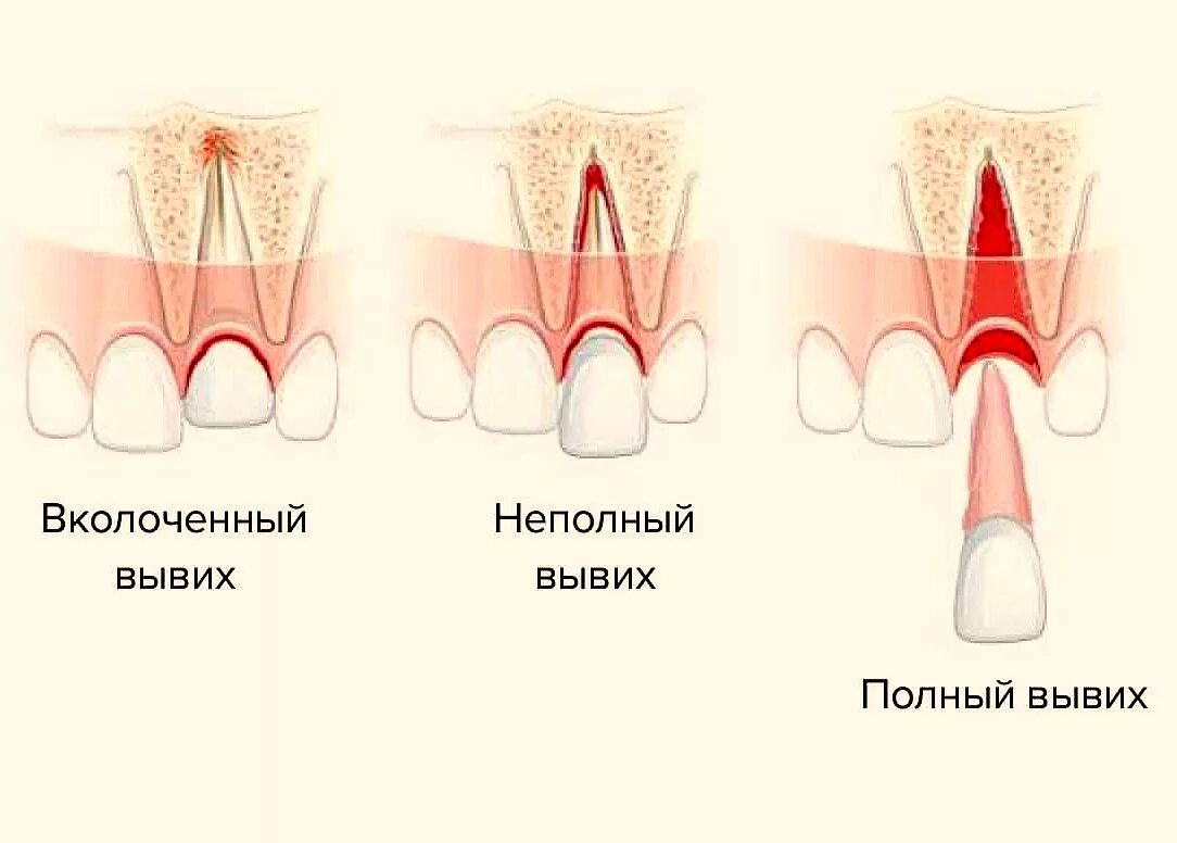 Трещина болит. Неполный вывих молочного зуба. Полный и неполный вывих зуба. Неполный вывих зуба рентген. Неполный полный вколоченный вывих зуба.