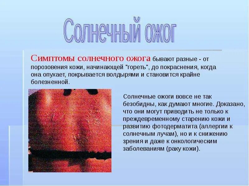 Сонник обжечь