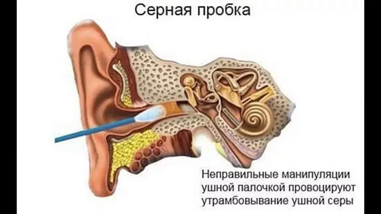 Почему одно ухо плохо. Строение уха ушная пробка. Серная пробка на барабанной перепонке. Внутреннее ухо серная пробка. Ушная сера в барабанной перепонке.